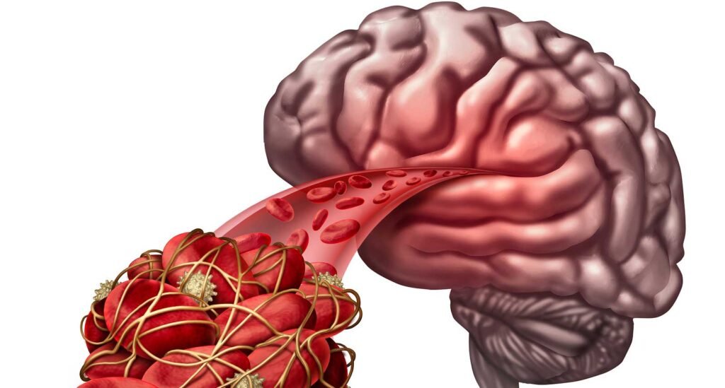 Expresión de la proteína espiga del SARS-CoV-2 en las arterias cerebrales: implicaciones para el accidente cerebrovascular hemorrágico posterior a la vacunación con ARNm